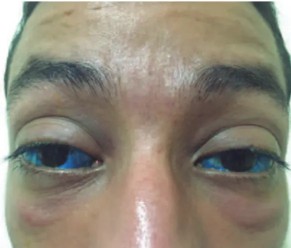 Figure 2. Blue deposits over the conjunctiva with conjunctival swelling.