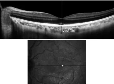 Figure 3. Optical coherence tomography image of choroidal thickness (CT) measure- measure-ment in a patient.