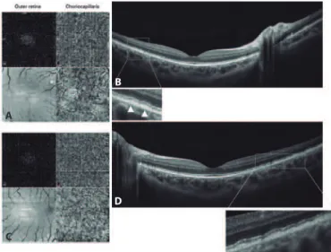 Figure 4. Optical coherence tomography (OCT) angiography with a split-spectrum  amplitude de correlation algorithm and structural en face OCT 3 × 3 mm (A and C),  which showed no macular injury from the outer retina to the level of choroid capillary  in bo