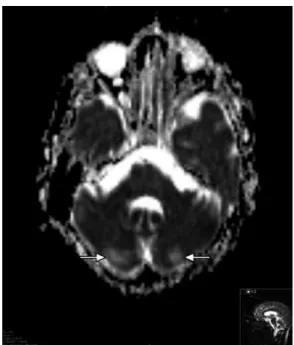 Figure 3. Apparent difusion coeicient map for the patient with pos- pos-terior reversible encephalopathy syndrome