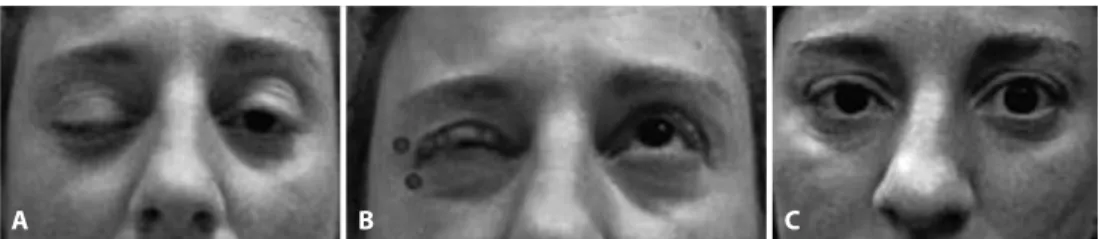 Figure 1. A) Inability to open her right eyelid prior to botulinum injection. B) Shown are the injection sites of 2 units per loci at  two regions (medial and laterally) of the pretarsal orbicularis in the upper right lid and 4 units subcutaneously per loc