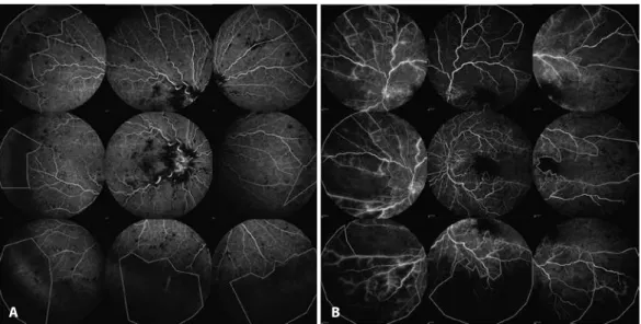 Figure 1. (A) and (B) Areas of capillary non-perfusion outlined in nine standard angiographic images from two diferent patients