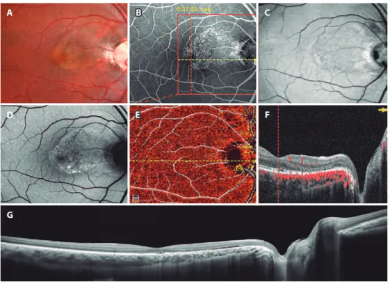 Figure 2. Postoperative multimodal imaging of the right eye: resolution of optic disc pit maculopathy in a 19-year-old man