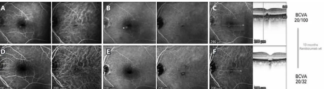 Figure 2. (Case 2): A) Early phase pre-treatment. Left: FA shows a small round hyperluorescent lesion inferonasal to the fovea