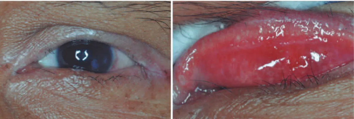Figure 1. Cicatricial entropion and corneal opacity in a young Maku female Indian. Left: signs of difuse upper eyelash epilation, angular  inlammation, and corneal opacity