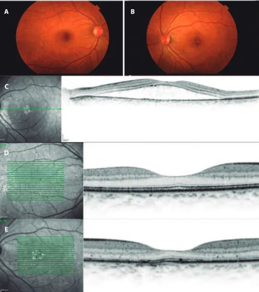 Figure 1. Retinography in OD (A) and OS (B). Yellowish lesions can be seen in the foveal topography of OS