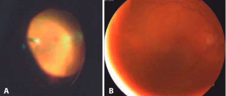Figure 2. A) Organized hypopion 5 months after the initial presentation (intraoperative  image, rotated to facilitate comparison); B) After 3 weeks: clear cornea and anterior  chamber with ixed mydriasis following injections of 250 µg/0.1 ml caspofungin.