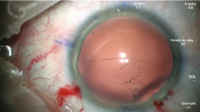 Figure 2. The tear in the posterior capsule extending into the periphery.