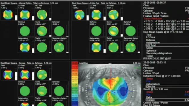 Figure 3. iTrace (Tracey Technologies LLC, Houston, TX, USA) aberrometry of the internal optics, revealing an astigmatism of 177º corresponding to  an intraocular lens axis of 87º as planned.