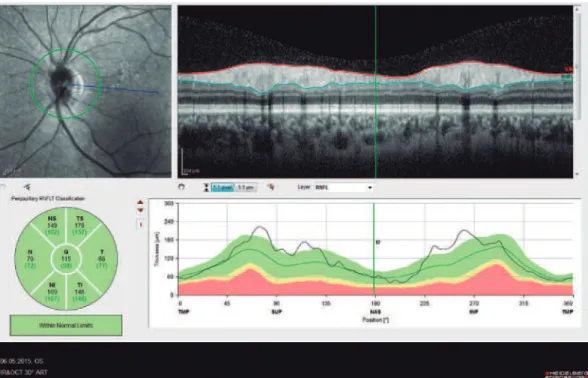 Figure 2. Spectral domain optical coherence tomography retinal nerve iber layer (RNFL) imaging of a normal eye.