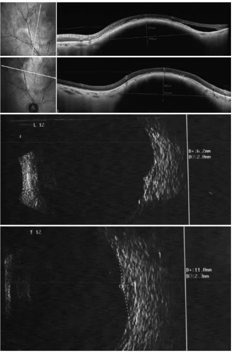 Figure 1. Choroidal nevus located at the posterior pole. Anteroposterior diameter, 6.2 (20-MHZ ultrasound  [US], lower left) and 5.59 mm (optical coherence tomography [OCT], top left); transverse diameter, 11.0   (20-MHZ US, lower right) and 6.12 mm (OCT, 