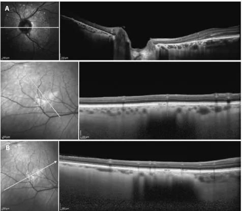 Figure 3. A) Choroidal nevus on spectral domain optical coherence tomography. Peripapillary location indica- indica-ting the limit between the choroid and sclera