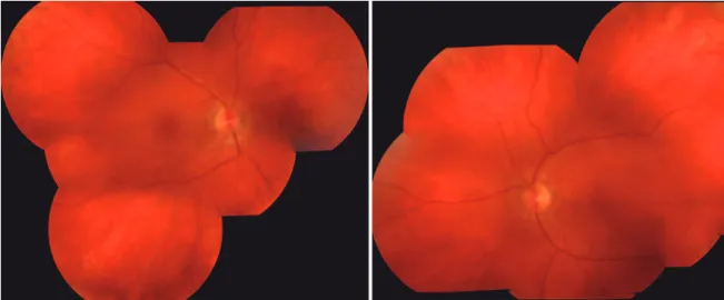 Figure 2. Optical coherence tomography (1-3), adaptive optics (A-H), and microperimetry (2-4) images of a patient with occult macular dystrophy