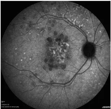 Figure 3. Large colloid drusen in a late-phase indocyanine green angiography  image with a hypoluorescent center surrounded by a hyperluorescent halo