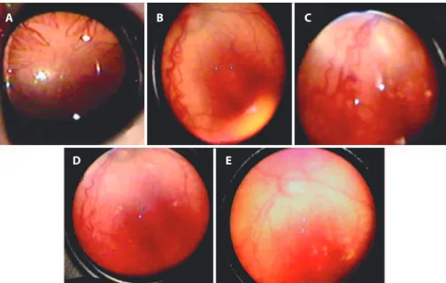 Figure 1. Series of photographs of a typical patient with aggressive posterior retinopathy of prematurity (case 13) treated  with intravitreal ranibizumab