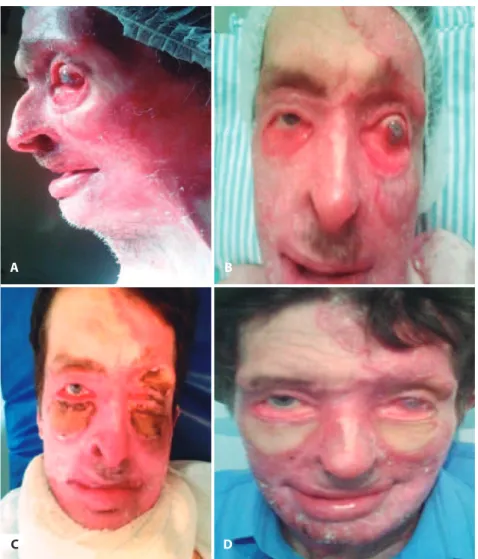 Figure 2. Preoperative and postoperative aspects showing severe ectropion leading to corneal exposure