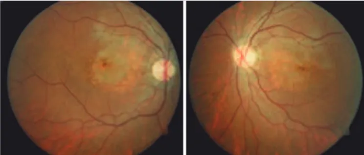 Figure 3. Primary macular pigmentary changes and atrophy of the retinal pigment  epithelium.