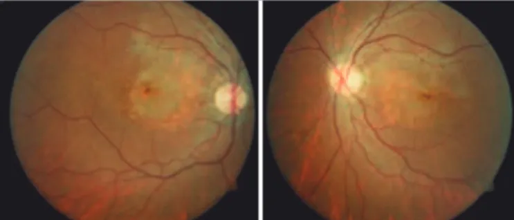 Figure 3. Primary macular pigmentary changes and atrophy of the retinal pigment  epithelium.
