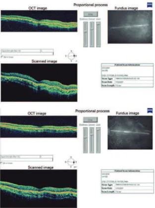 Figure 4. Optical coherence tomography demonstrating a mild decrease  in macular thickness bilaterally.