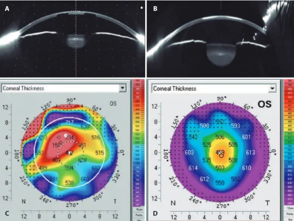 Figure 5. Confocal evaluation obtained during the follow-up. (A) 1 month after implantation showing the pores of the inlay; 