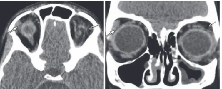 Figure 2. Case 2. Orbital computed tomography (CT) scan. Coronal (right) and axial (left)  images revealing absence of left lacrimal gland (black arrow) compared to the normal  contralateral right side (white long arrow).