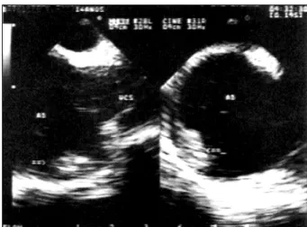 Fig. 2 - Radiografia de tórax. Aumento da área cardíaca, às custas de cavidades direi- direi-tas