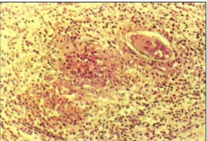 Fig. 7 - Detalhe de uma das lesões granulomatosas da zona da fibrose do endocárdio.