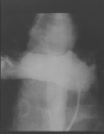 Fig. 1 - Arteriografia pulmonar mostrando a interrupção ao fluxo de contraste na artéria pulmonar esquerda após sua origem.