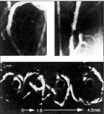 Fig. 1 - Portador de angina instável e evidência angiográfica de trombo no terço mé- mé-dio da artéria coronária direita (seta), tratado com heparina intra-venosa por 7 dias.