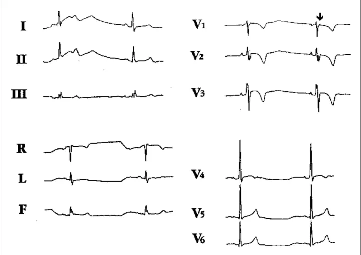 Fig. 1- Eletrocardiograma de 12 derivações de portador de DAVD. Observar a presença de inversão da onda T em precordiais direita, QRS de duração &gt;110ms e distúrbio de condução pelo ramo direito