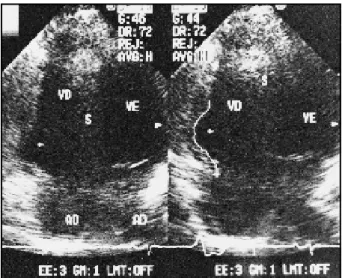 Fig. 3 - Eletrocardiograma de 12 derivações de taquicardia ventricular em portador de displasia arritmogênica do ventrículo direito