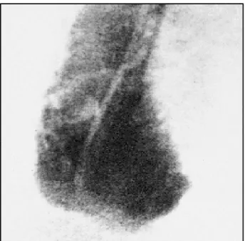 Fig. 5 - Angiografia ventricular direita em incidência oblíqua anterior direita apre- apre-sentando expansão aneurismática em região septal inferior.