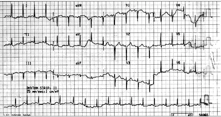 Fig. 1 - Eletrocardiograma: sobrecarga atrial esquerda e alterações difusas da repolarização ventricular.