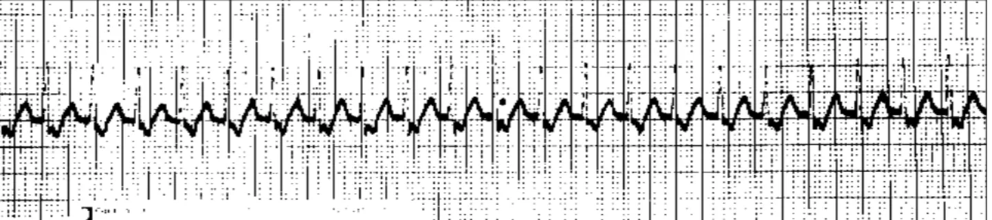 Fig. 2  - Taquicardia supraventricular com freqüência cardíaca de 170bpm detectada por registrador de evento.