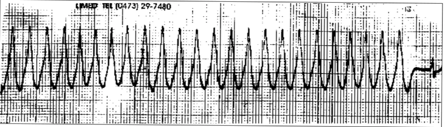 Fig. 5 - Taquicardia ventricular monomórfica sustentada com freqüência cardíaca de 220bpm e detectada por registrador de evento.