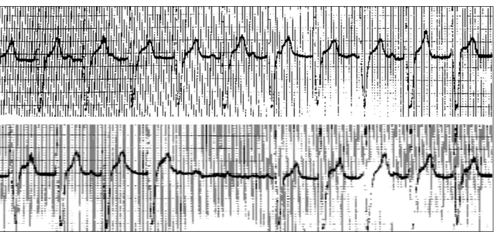 Fig. 6 -  Oversensing detectado por registrador de eventos em marcapasso ventricular unipolar, gerando ausência de estimulação e pré-síncope