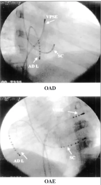Fig. 1 - Fluoroscopic image of electrophysiologic catheters in right (RAO) and left (LAO) anterior oblique projections