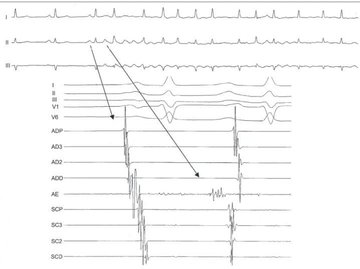Fig. 4 - Electrogram at the site of RF application. Note that atrial premature beat that initiates atrial fibrillation is regis tered earlier when compared to the remaining electrograms.