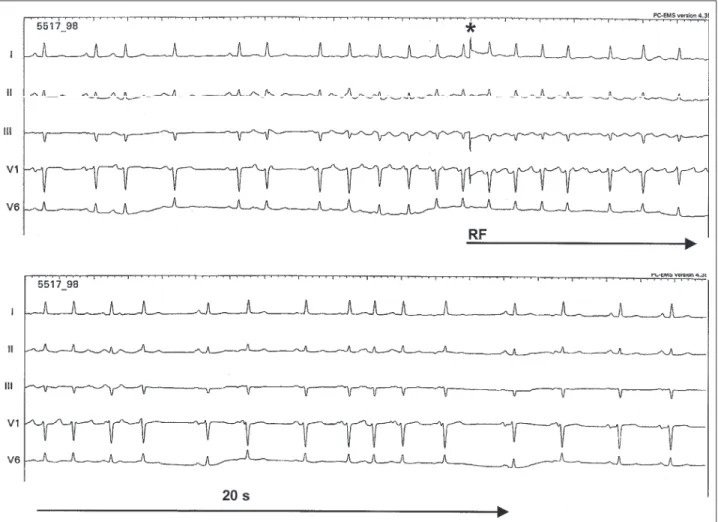 Fig. 5 - Atrial fibrillation interruption during RF pulse application. I, II, III, V1, and V6: body surface ECG leads, continuously recorded at the speed of 25 mm/sec