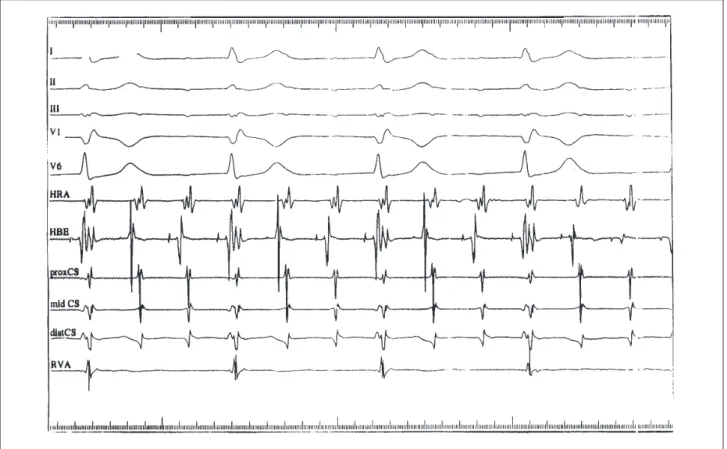 Fig. 1 - AVNRT of the common type with 3:1 conduction block to the ventricles and 1:1 concentric retrograde atrial activation