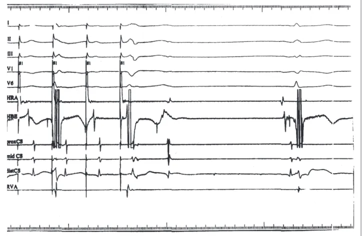 Fig. 3 - Atrioventricular nodal reentry echo beat with the same retrograde atrial activation seen in figure 1 (during tachycardia) and with infra-Hisian block observed at the end of atrial burst pacing with a cycle length of 350ms