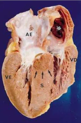 Fig. 3 - Corte longitudinal do coração demonstrando acentuada hipertrofia do ventrículo esquerdo, assimétrica, com maior espessura do septo ventricular (S)