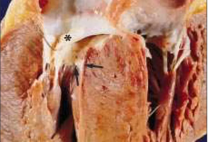 Fig. 4 - Detalhe da figura anterior. A cúspide anterior da valva mitral acha-se espessa- espessa-da (asterisco) e está parcialmente rebatiespessa-da, deixando à mostra a “imagem em espelho da cúspide anterior” no endocárdio da via de saída do ventrículo es