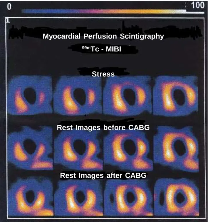 Fig. 4 - Myocardial perfusion scintigraphy with  99m Tc-MIBI and tomographic slices in the oblique plan