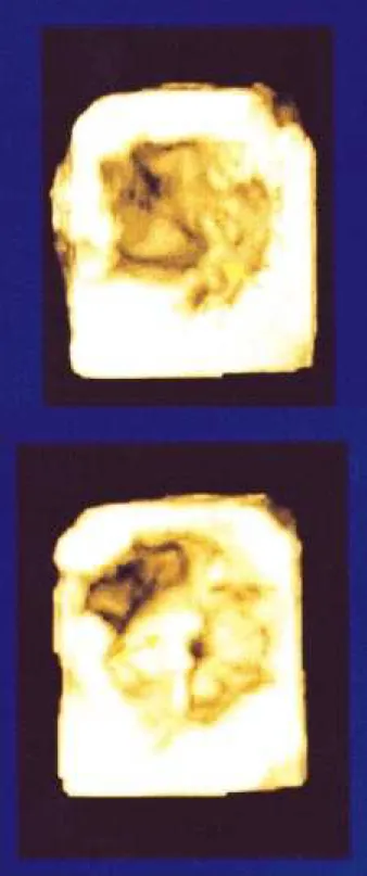 Fig. 1 – 3D reconstruction in a patient with mitral valve prolapse: A) mitral valve seen from the  ventricular perspective