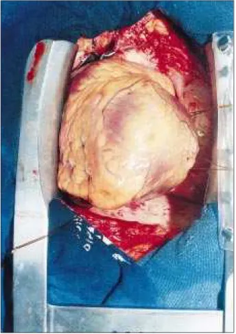 Fig. 1 – Exposure of the posterior coronary arteries after right mediastinal rotation through traction of the threads inserted to the left of the posteroinferior area of the pericardium.