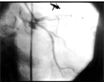 Fig. 1 – Diffuse restenotic lesion.