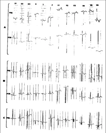 Fig. 1 - Electrocardiographic findings in AOLCA. A) Electrocardiogram before surgery (PRE), case # 9: QRS at 0°, left chambers hypertrophy, deep Q wave in lead AVL and significant ventricular repolarization abnormalities in the anterolateral wall