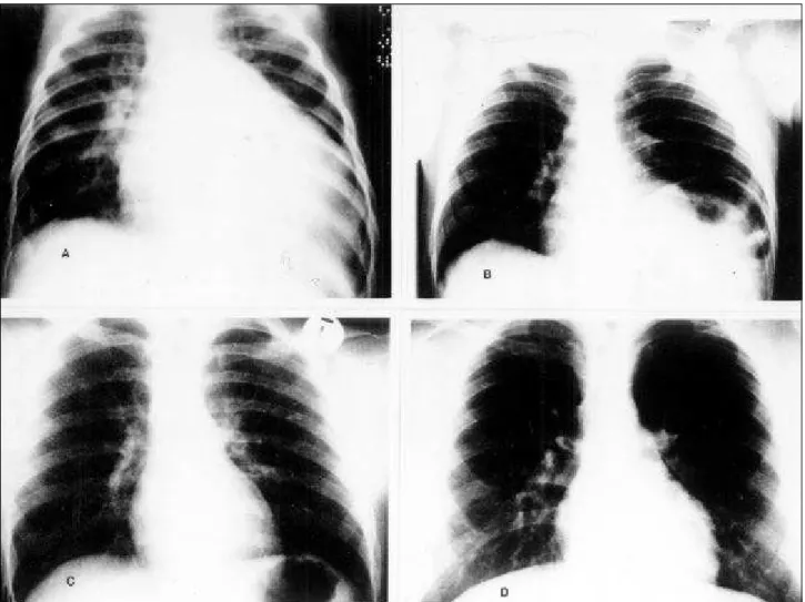 Table I – Clinical and laboratory data from 11 patients diagnosed with AOLCA.