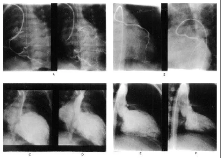 Fig. 3 – Cardiac catheterization in AOLCA. Case # 9: A) a preoperative angiography of the right coronary artery: fistulous communication with the LCA and the pulmonary trunk.